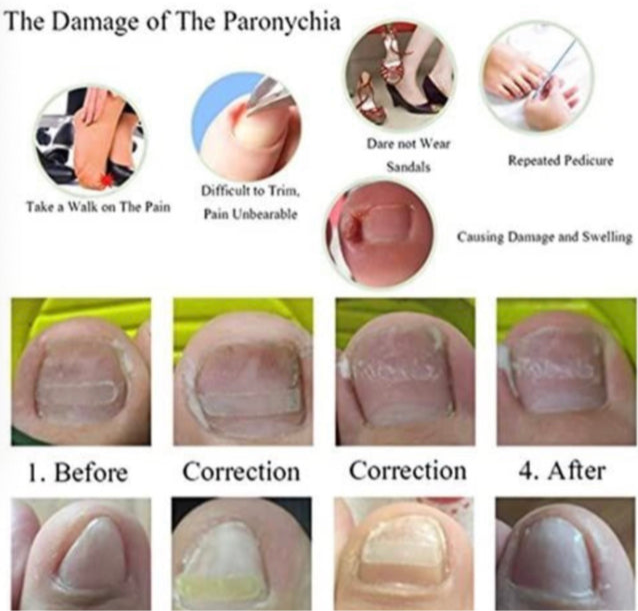 Toenail Straightening - 12pcs