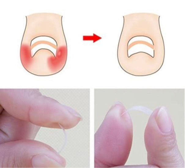 Toenail Straightening - 12pcs